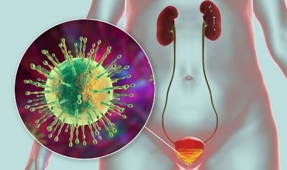 Differentiating lower tract urinary infection (bladder) from upper tract inf